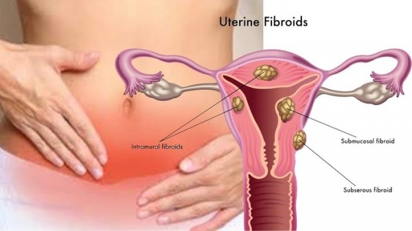 ▲ 갱년기, 갑상선 종양, 수족냉증 등과 더불어 대화에서 가장 빈번하게 오르내리는 질환 중의 하나가 자궁근종이다.