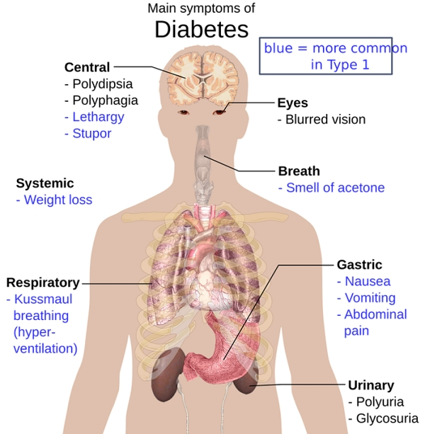 ▲ 당뇨병이 생기면 10년 내에 약 30%가 당뇨망막증이 오고, 60%가 발 질환이 생겨 심한 경우 발을 절단해야 한다. 전체 심장질환의 60%, 신장질환의 30%가 당뇨병으로 인한 합병증이다.